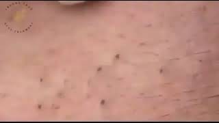 Using sharp tip to remove blackhead - Usando ponta afiada para remover Cravo