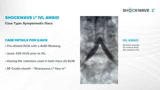 Shockwave L6 in Action: Calcified Bilateral Iliacs - Prepping for Stents