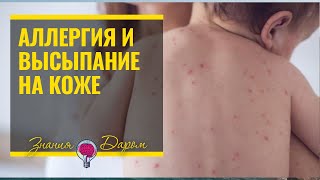 КАК ОПРЕДЕЛИТЬ АЛЛЕРГИЧЕСКОЕ ВЫСЫПАНИЕ НА КОЖЕ