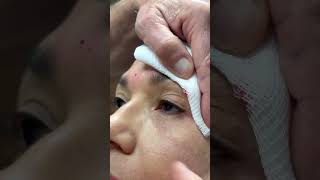 Upper + Lower Blepharoplasty Follow-Up & Botox: How to Look Refreshed and Natural!