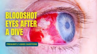 FAQ Bloodshot eyes after diving