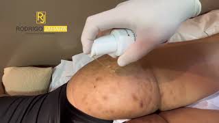 Peeling clareador corporal