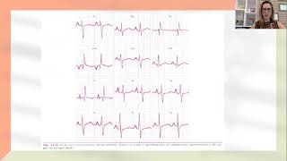 Sobrecarga no Eletrocardiograma