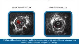 Phoenix with IVUS Case Review - Joseph Griffin, MD