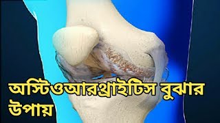 কীভাবে বুঝবেন আপনার অস্টিওআর্থ্রাইটিস?-হাঁটুর ব্যথা থেকে মুক্তির উপায়-  হাঁটুর ব্যথার জন্য ব্যায়াম