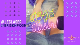 💃🏽 Full Legs Laser Hair Removal Experience 💃🏽