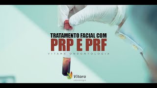 Tratamento facial com PRP & PRF / Dr. Eula Cunha /  Vitara Odontologia Caratinga Minas Gerais