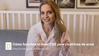 Cómo funciona el láser CO2 para eliminar las cicatrices de acné | Dermaforyou by Dra Carmen Galera