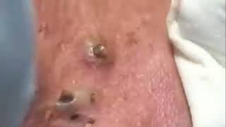 08 A BIG BLACKHEADS BEHIND THE EAR 😨 GREAT JOB JOSEFA #relaxing  #blackheads