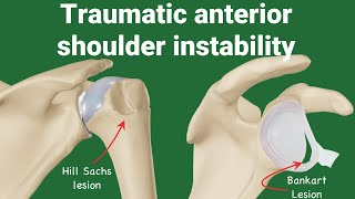 Pathologies of Traumatic Anterior Shoulder Instability (TUBS) animation