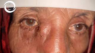 Ophthalmic Signs Adnexa