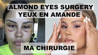 MA CHIRURGIE DES YEUX EN AMANDE / BELLA EYES & ALMOND EYES / PONYTAIL LIFT /