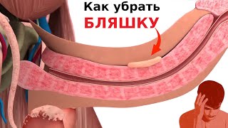 Как избавиться от БЛЯШКИ на половом члене / Болезнь Пейрони