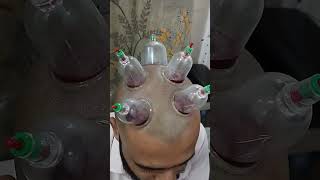 Unlocking the Secrets: Hijama Cupping Therapy for Your Head #alternativemedicine #education