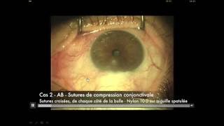 Sutures de compression conjonctivale   (Alain Bron)