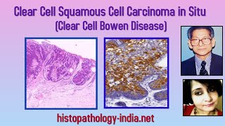 Clear Cell Squamous Cell Carcinoma  in Situ / Clear Cell Bowen Disease - Dr Sampurna Roy MD