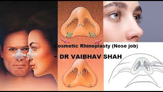 Cosmetic Rhinoplasty! Nose job in Mumbai! Cost, Details, Procedure, Surgeon