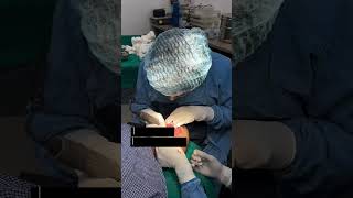 Hair Transplant Surgery Step 2 Punching | Graft Harvesting | FUE Hair Transplant #shorts #viral