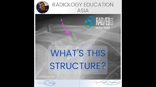 WHAT'S THIS STRUCTURE? CORACOCLAVICULAR JOINT NORMAL VARIANT RADIOLOGY X-RAY