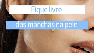 Saiba + sobre sol e melasma !