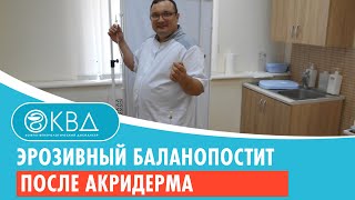 💣 Эрозивный баланопостит после акридерма. Клинический случай №783