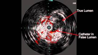 Pioneer IVUS Run   Case 2 Run 2