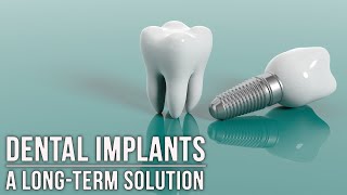 Three questions you should ask before getting dental implants.