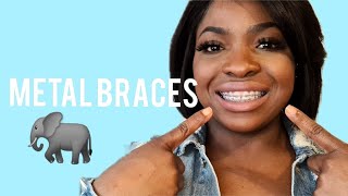 My Journey So Far With Metal Braces