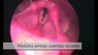 Lesiones en cuerdas vocales y laringe