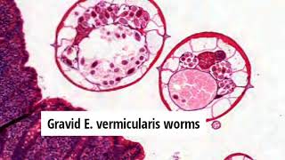 Pathology of Enterobiasis - Enterobius Vermicularis (Pinworm) Infection by Dr Sampurna Roy MD