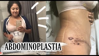 Mi experiencia con la ABDOMINOPLASTIA/ TUMMY TUCK