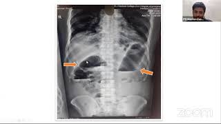 Surgical audit: Closed loop obstruction