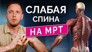 Эволюция подарила нам остеохондроз. Объясняю на МРТ, почему разрастаются суставы и болит спина