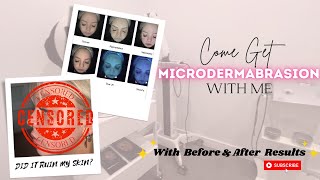 DID MICRODERMABRASION RUIN OR FIX MY SKIN??? || COME GET A FACIAL WITH ME EP 1