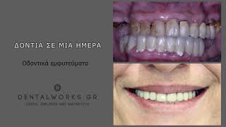 Teeth in a day | Δόντια σε μια μέρα | Περιστατικό