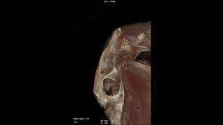 Head Trauma Captured With Standing CT