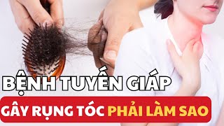 Bệnh Về Tuyến Giáp Có Gây Rụng Tóc Không ? Rụng Tóc Do Tuyến Giáp Phải Làm Gì ? Bác sĩ Chiều