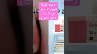 روشتة كامله لتورم الاصابع في الشتاء (عضة الصقيع)