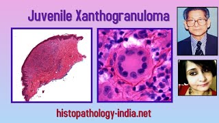 Pathology of Juvenile Xanthogranuloma - Dr Sampurna Roy MD ( dermpath, Dermatopathology)