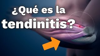 QUÉ ES LA TENDINITIS y qué hacer para curarla rápido