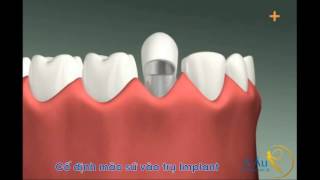 Cấy ghép Implant  - Tiến sĩ, Bác sĩ Huỳnh Đại Hải thực hiện | 3D Company