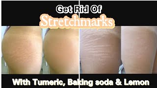 How to get rid of stretch marks in 7 days with Tumeric, Baking soda and Lemon