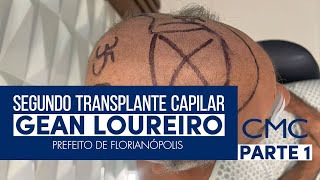 2º TRANSPLANTE CAPILAR - GEAN LOUREIRO PARTE 1