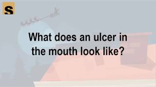 What does an ulcer in the mouth look like | Health Herald