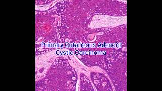 #Histopathology of Primary Cutaneous Adenoid Cystic Carcinoma #dermpath  #dermatopathology #shorts