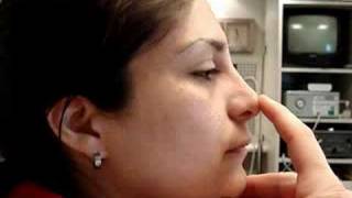 Rinoplastia Punta Nasal Caida y Debilitada