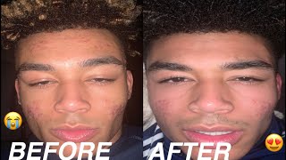 THIS PRODUCT CLEARED MY SKIN IN 1 WEEK