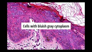 Pathology of Epidermodysplasia Verruciformis by Dr Sampurna Roy MD (dermatopathology, dermpath)