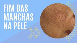 Você pode ser a próxima a renovar a sua pele e autoestima ! #melasma #skincare #cuidadosdapele #pele