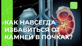 Камни в почках: полезные привычки предотвращения болезни